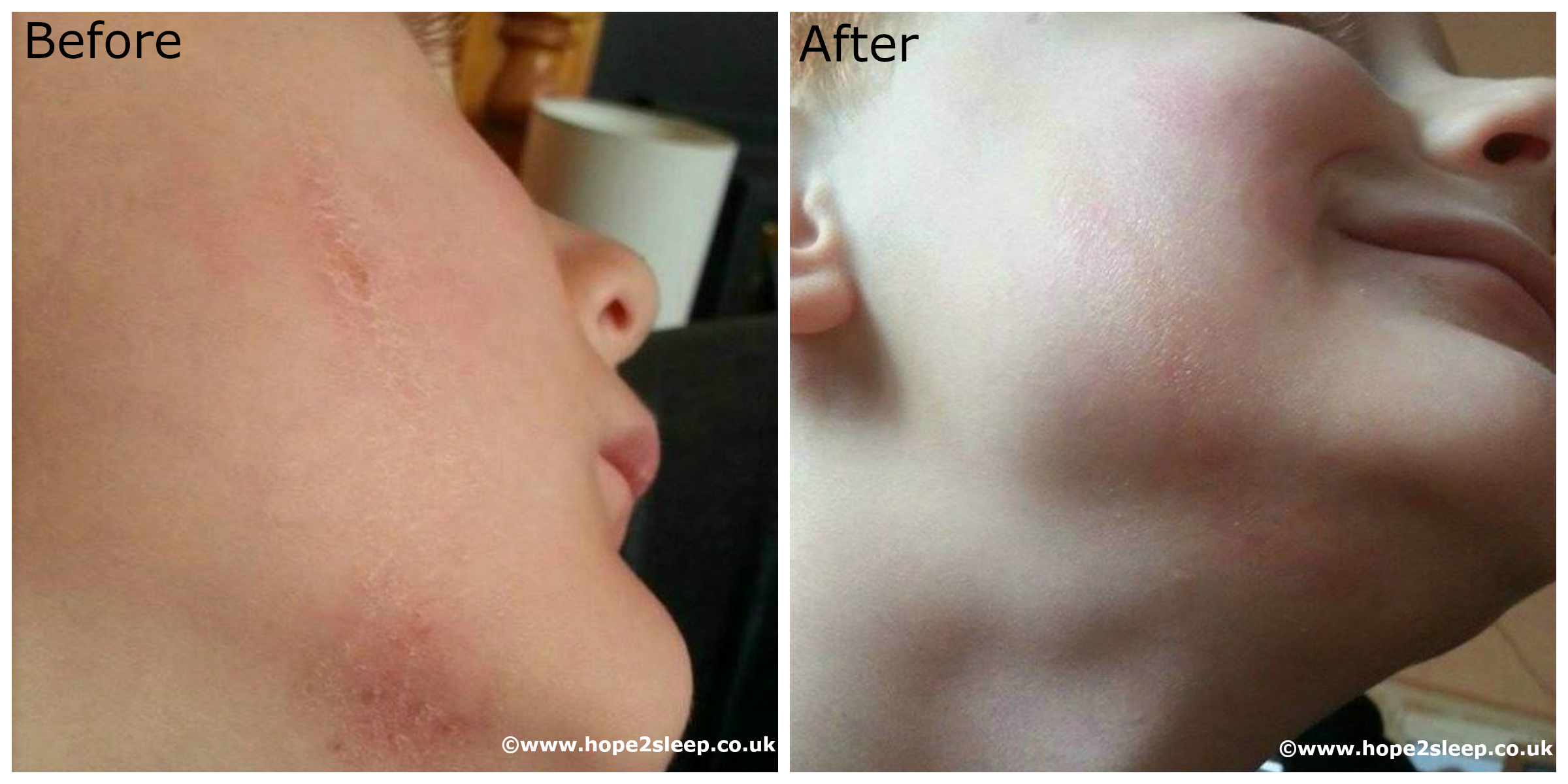 Before and After Image - CPAP Moisture Therapy Cream